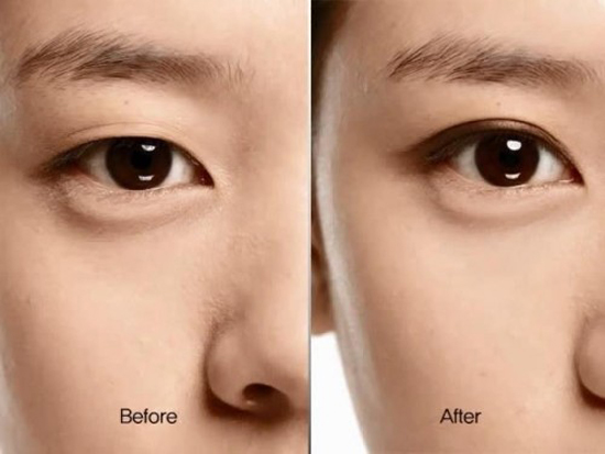 3 sai lầm về cắt mí mắt